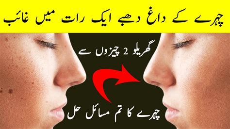 Chehry K Dag Dhaby Door Karne Ka Totka How To Remove Dark Spots