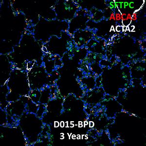 Year Human Lung Sftpc Abca And Acta Confocal Imaging