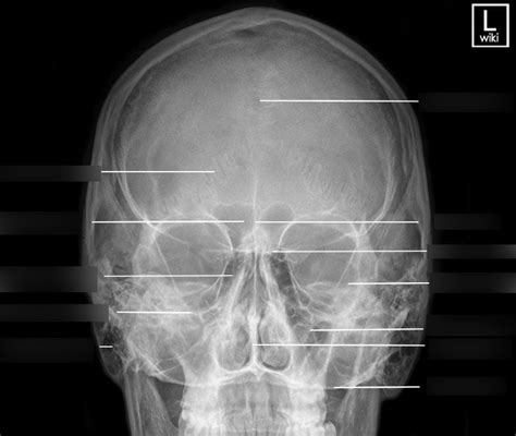 Facial Bones Diagram | Quizlet