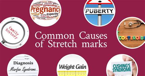 Your Uncut Guide To Stretch Mark Causes And Solutions