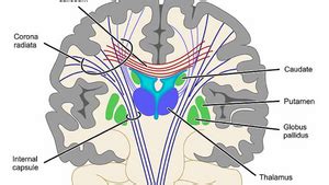 Internal Capsular Stroke - Physiopedia