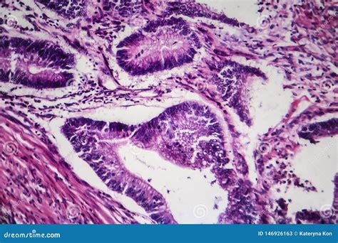 Colon Cancer Light Micrograph Stock Illustration Illustration Of