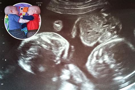 Identical Twins Kept Each Other Alive By Holding Hands In The Womb ...