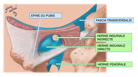 Qu est ce que c est la hernie inguinale Dr méd Vincent Ott FMH