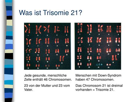 Ppt Down Syndrom Trisomie 21 Powerpoint Presentation Free Download