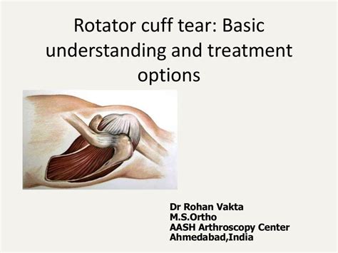 Rotator Cuff Tear And Its Management