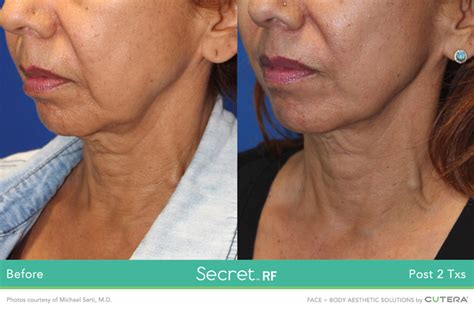 Secret Rf Refine Rf Micro Needling Full Face South William Clinic And Spa