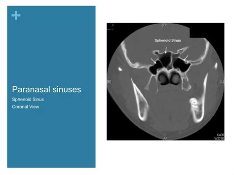 Nasal Cavity And Paranasal Sinuses Radiologic Anatomy Ppt