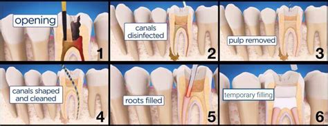 Root Canal Therapy Endodonticsla