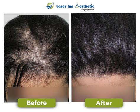 Laser Inn Best Hair Transplant Results Best Fue Hair Transplant