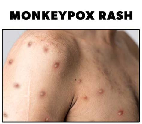 Monkeypox Everything Nurse S Need To Know When Caring For Monkeypox