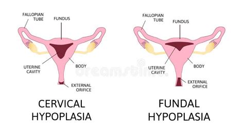 Hipoplasia Uterina útero Ou útero Infantil Ilustração Stock