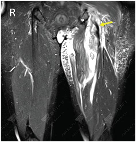 Mri For Hamstring Injury