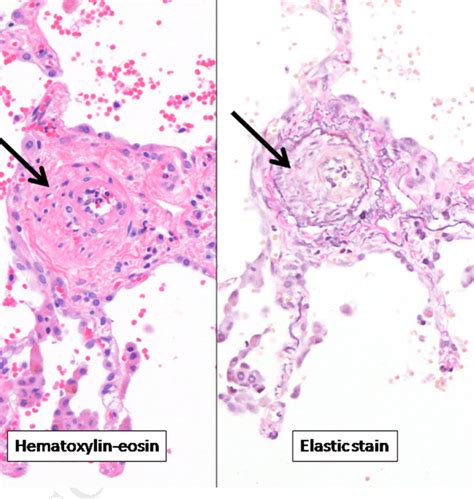 Lung biopsy pathology slides. Subpleural vein in intralobular septum ...