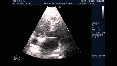 Estenosis Aortica En Varon De 51 A Dr Pedro Guillermo Bustos Nov 2013
