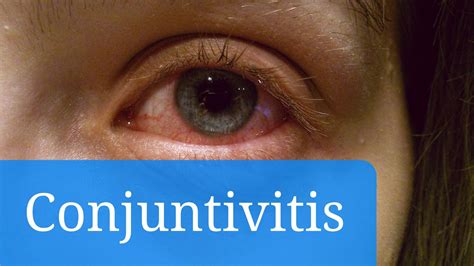 Conjuntivitis Vírica Alérgica Y Bacteriana Síntomas Y Tratamiento