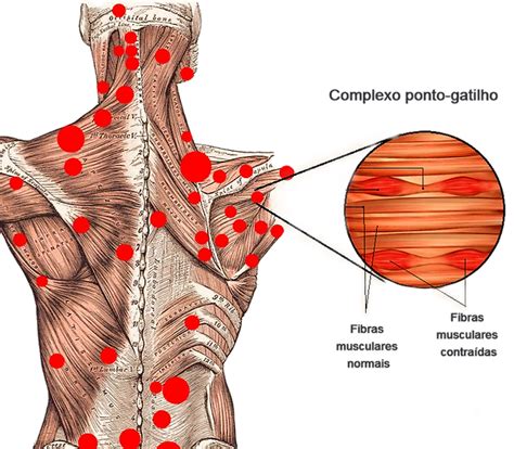 S Ndrome Miofascial E Pontos Gatilhos Benef Cios Da Libera O Miofascial
