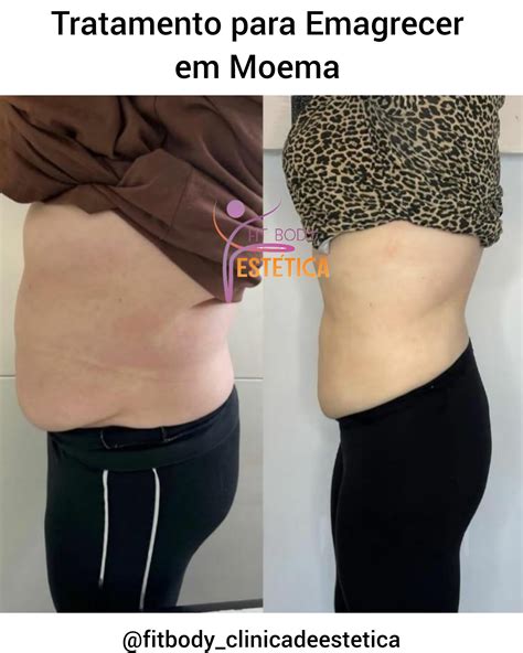 Tratamento Para Emagrecer Em Moema Cl Nica Fit Body Est Tica