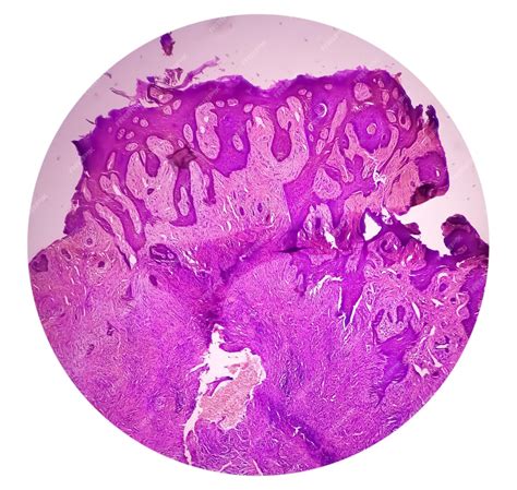 Biopsia De Piel Bajo Microscopía Sugestiva De Carcinoma De Células