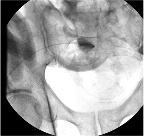 A Fluoroscopic Spot Image Showing A French Kumpe Diagnostic Catheter