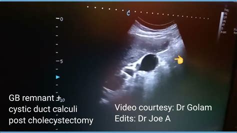 Post cholecystectomy, calculi in Gallbladder remnant, stump and cystic ...