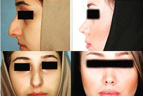 Persian Rhinoplasty Before After 8 Rhinoplasty Cost Pics Reviews