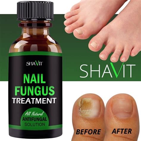 ANTI FUNGAL Toenail Fungus Treatment Extra Strength - Antifungal Nail ...