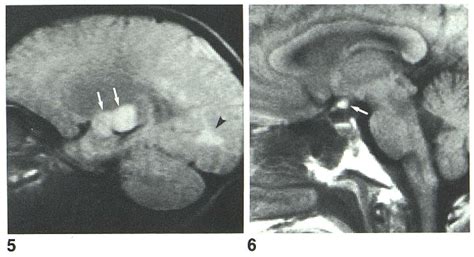 [PDF] MRI of optic chiasm and optic pathways. | Semantic Scholar