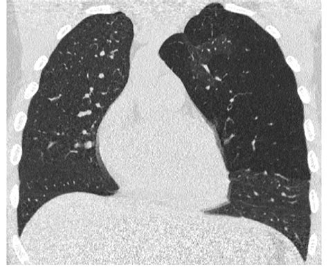 Pathology Diagnosis Congenital Lobar Emphysema Radiological Diagnosis