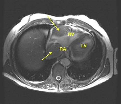 Cardiac MRI three-chamber view. The arrows denote the intracardiac ...