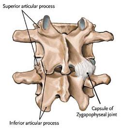 Facet Joint Syndrome » SONSA