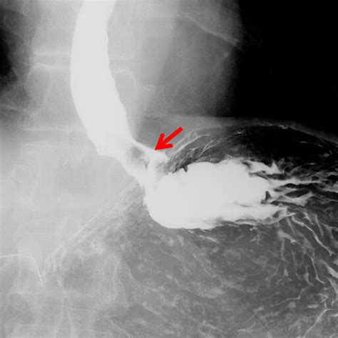 Barium Esophagogram Shows A Filling Defect In The Esophagogastric