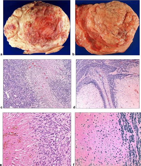 Gross Morphology And Histology Of Apoplectic Leiomyoma A Gross