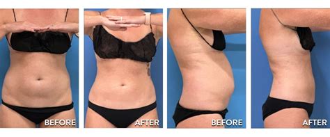 Smartlipo Before After Pictures Laser Lipo Results Photos