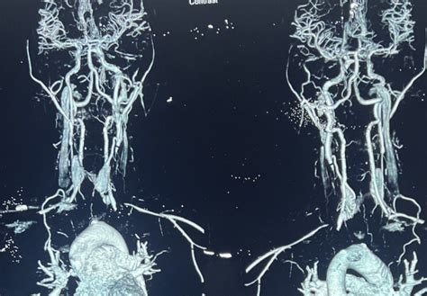 A Case Of Takayasu Arteritis In A Young Female Clinical Features