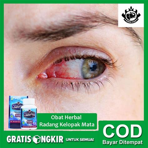 Jual Obat Herbal Radang Kelopak Mata Blefaritis Kelopak Mata Bengkak