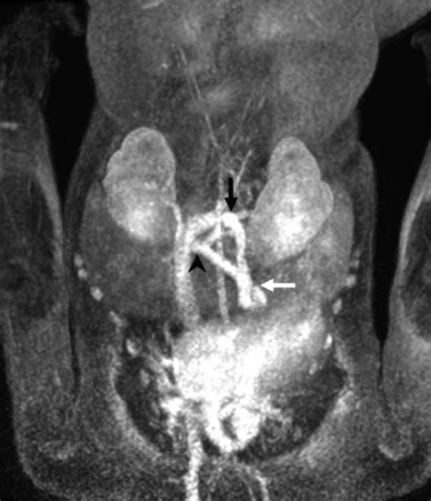 Full Body Magnetic Resonance Imaging Angiogram Image Coronal Maximum