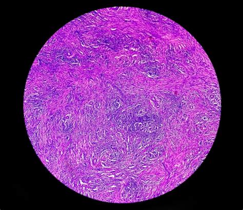 Visão Microscópica Do Carcinoma Basocelular é Um Tipo De Câncer De Pele