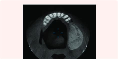 Cbct Sections Showed Mixed Radiopaque Radiolucent Predominately