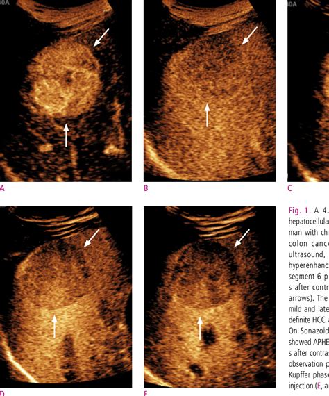 Figure 1 from The Principle of Contrast-enhanced Ultrasound and the Diagnosis of Hepatocellular ...