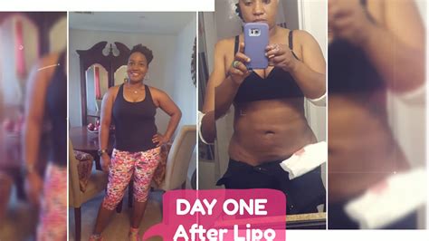 Lipo Pics Before After Liposuction Journey I Dont Own The