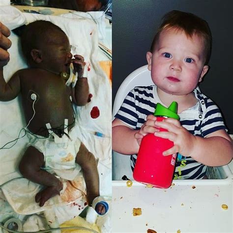 Photos Of Premature Babies Then And Now Show Their Incredible Journey