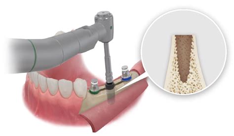 Esset Kit Hiossen Implant