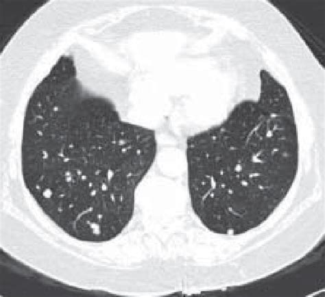 Figure 1 From Pulmonary Epithelioid Haemangioendothelioma Interferon 2