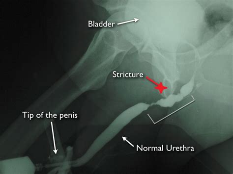 Urethral Stricture Disease: Causes, Symptoms, Diagnosis & Treatment with homeopathic medicine