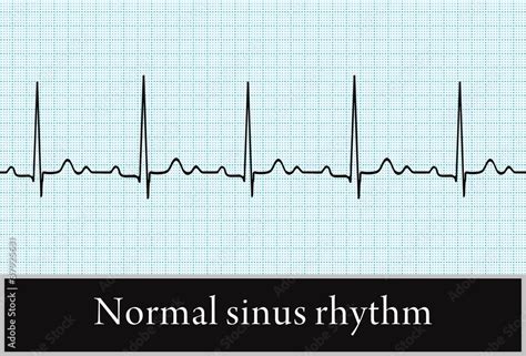 normal sinus rhythm. the vector. Information for professional Stock ...