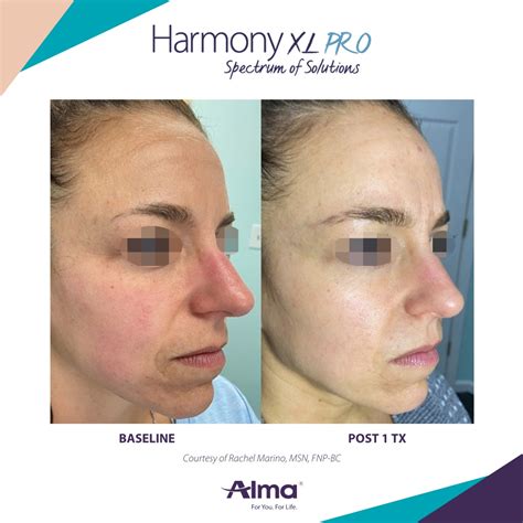 Rosacea Treatment Before And After