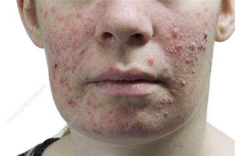 Faces With Acne Vulgaris