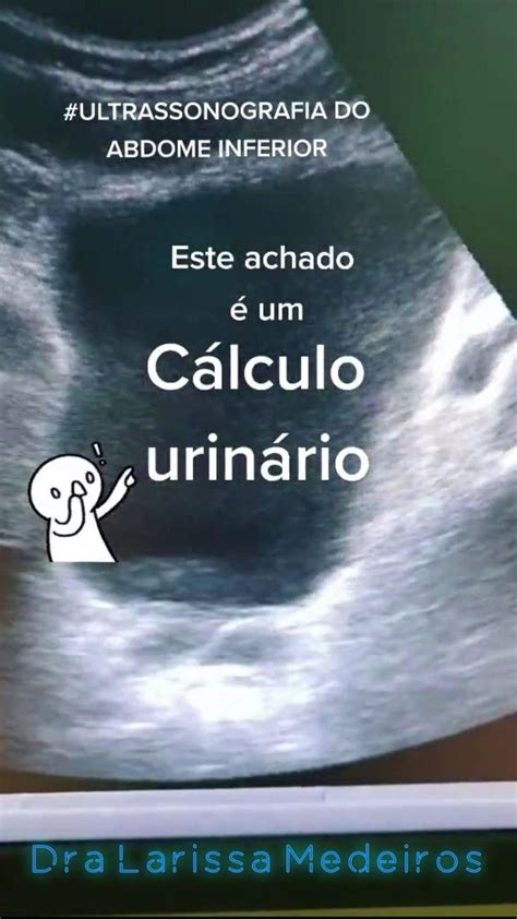 Cálculo de bexiga na ultrassonografia Calculus Study guide Health