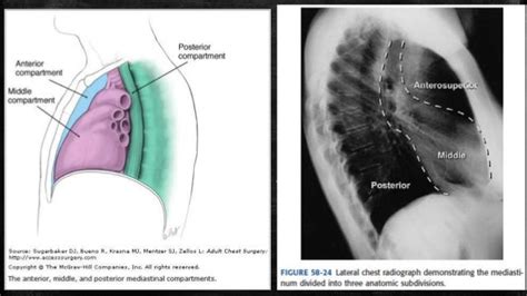 Mediastinal tumor